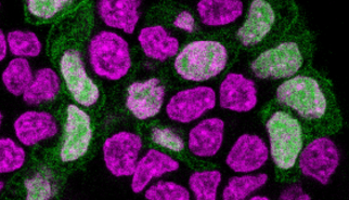 A SAGA of instability: Without scaffold, a key driver of childhood leukemia falls apart A SAGA of instability: Without scaffold, a key driver of childhood leukemia falls apart